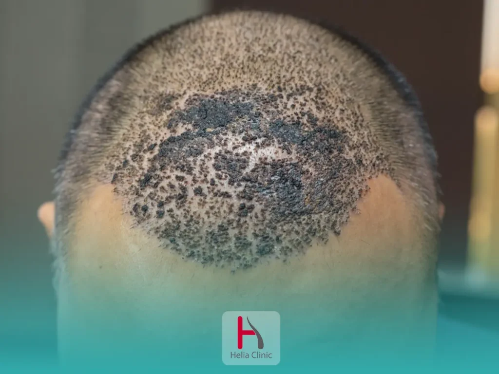 hair transplant side effects