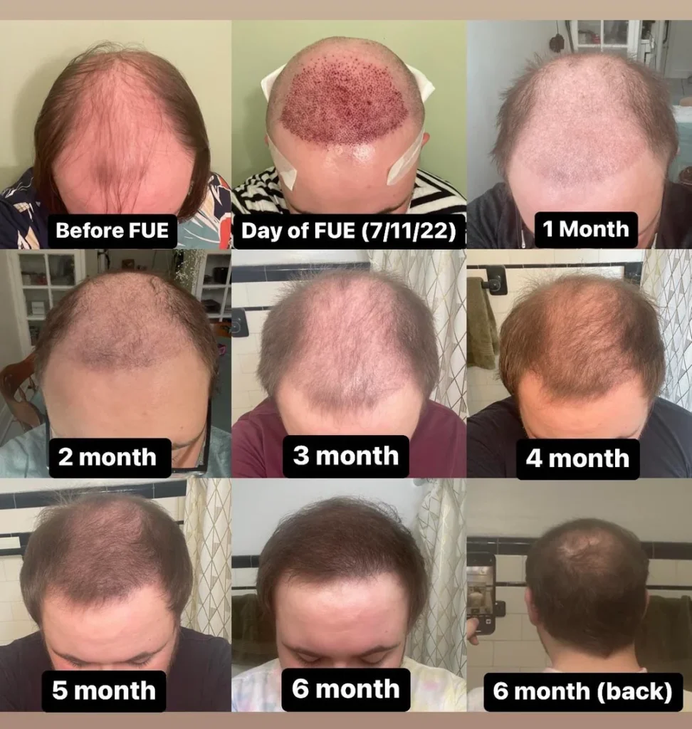 hair transplant recovery timeline